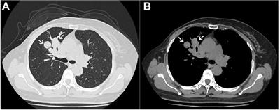 Case report: Osteosarcomatous differentiation in the lung metastasis of a malignant phyllodes tumor